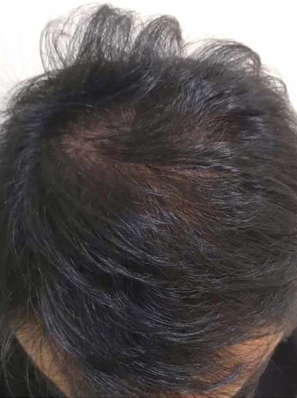 Crown density after 3 months of consistent use