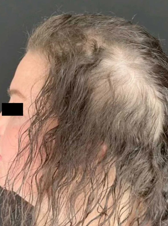 Hairline & temple before consistent use
