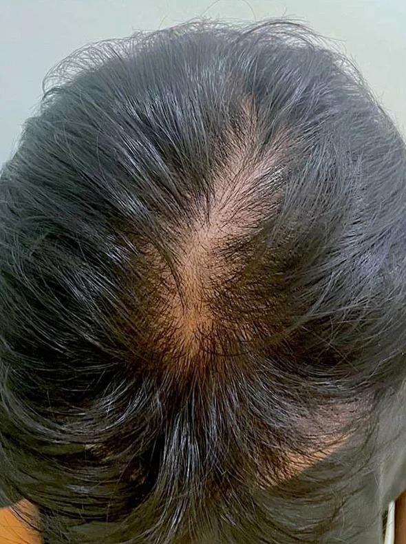 Crown density before consistent use
