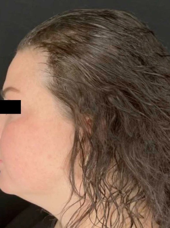 Hairline & temple after consistent use